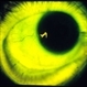 Choroideremia